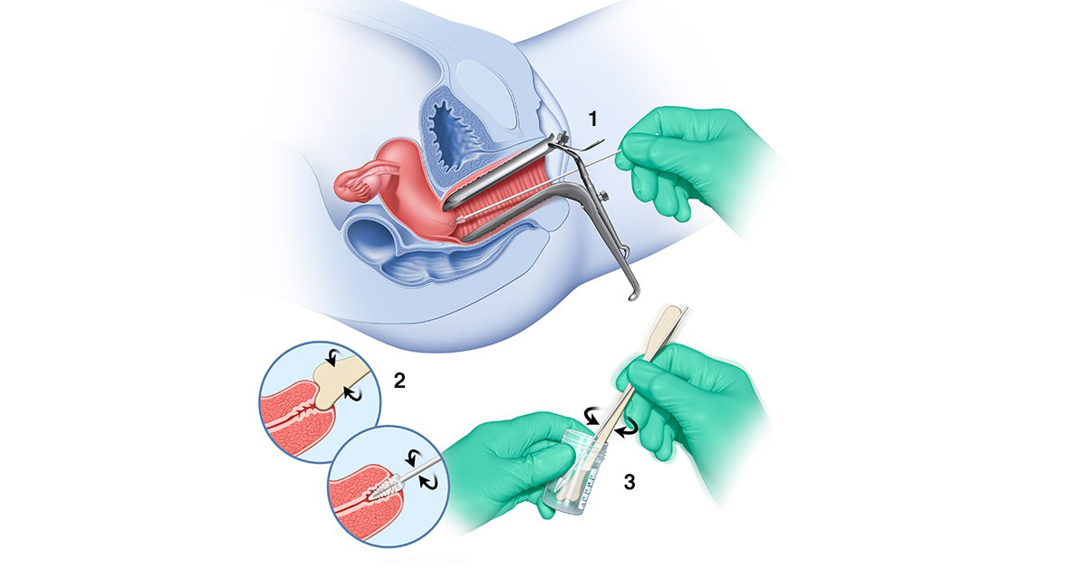 Мазок у гинеколога. Цервикальный канал взятие мазка. Мазок на цитологическое исследование техника забора. Техника взятия мазка на флору. Забор мазков на степень чистоты влагалища.